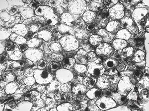 M, 14y. | pheochromocytoma M, 14y. | pheochromocytoma